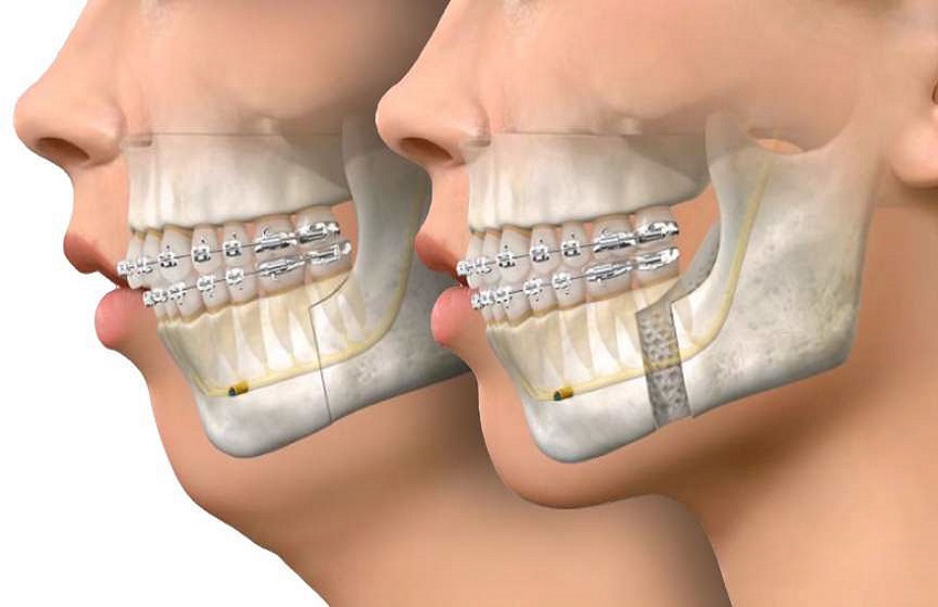 How Does Corrective Jaw Surgery Work